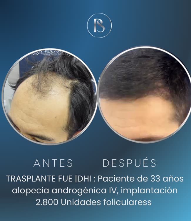 Trasplante Capilar Paciente p1