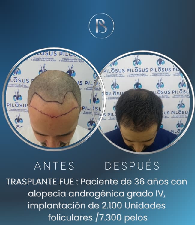 Trasplante Capilar Pilosus p11
