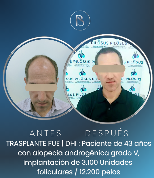 Trasplante Capilar Pilosus p13