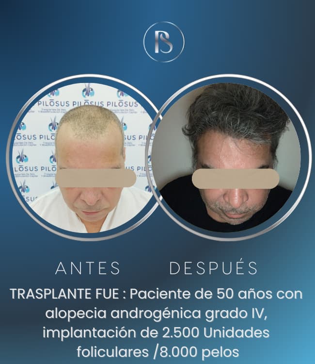 Trasplante Capilar p9